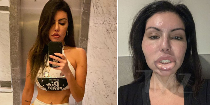 Popular Instagram model, Liziane Gutierrez, has suffered a swollen face aft...